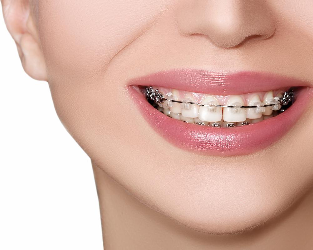 Best Orthodontic Treatment in Dubai