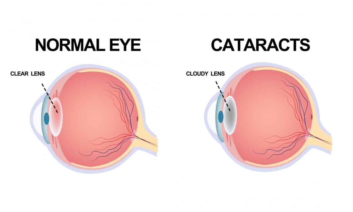 Cataract Surgery: Recovery and Treatment
