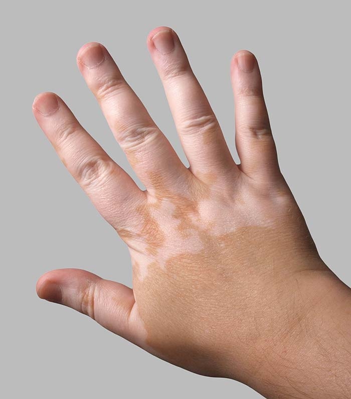 vitiligo treatment Sydney