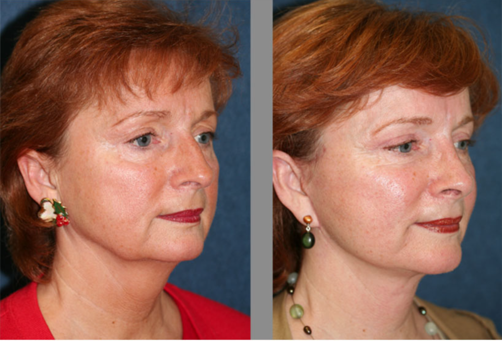 Facial Plastic Surgery: Enhancing Your Natural Beauty