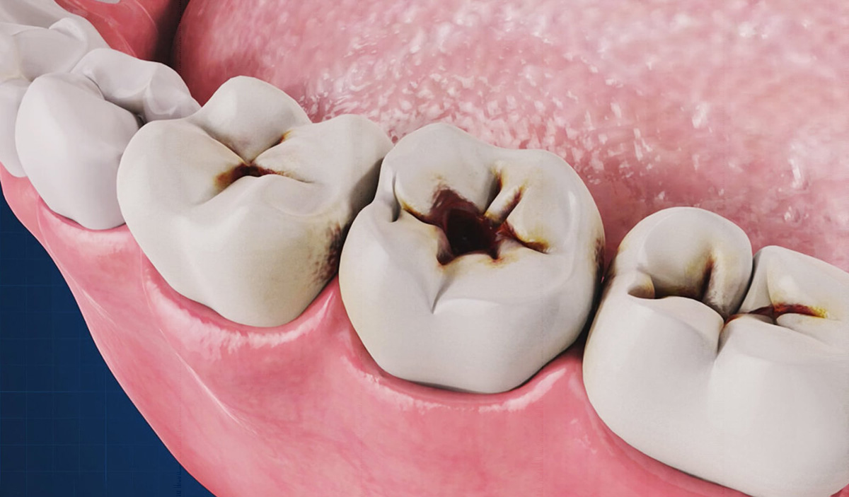 Tooth Cavity: Understanding Tooth Decay and Keeping Your Smile Healthy