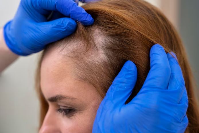stem cell therapy and hair loss in delhi