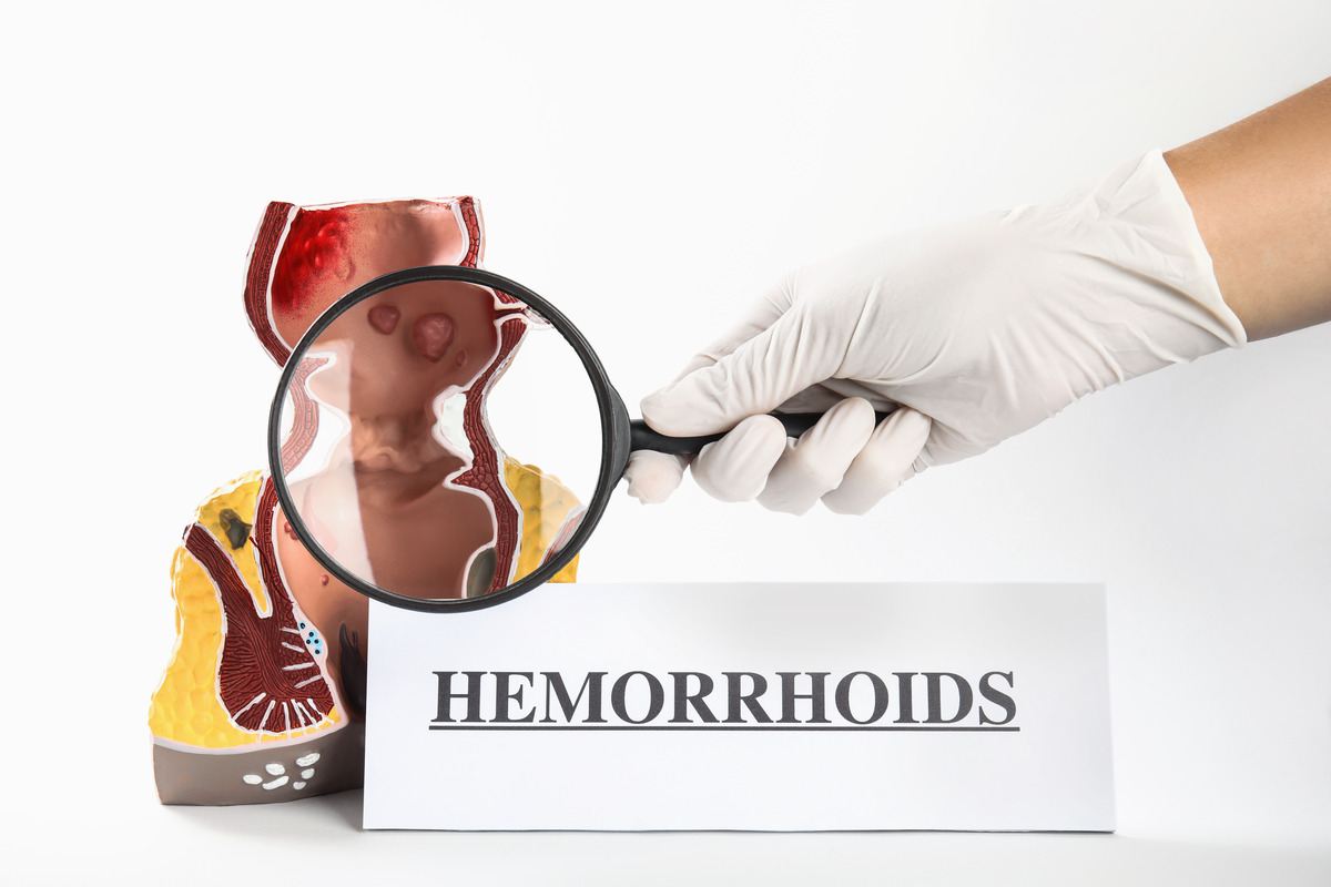 hemorrhoid treatments