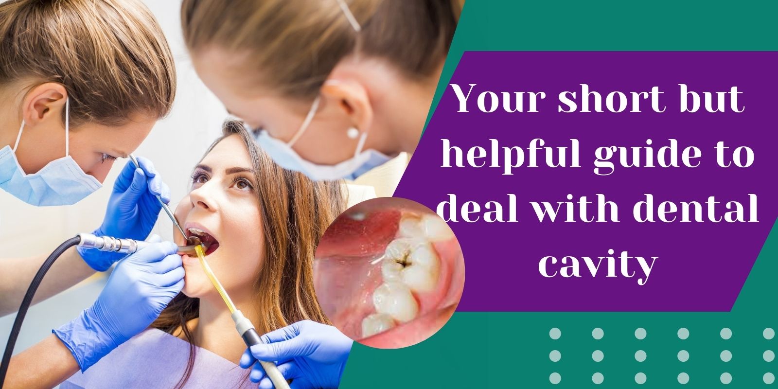 Your short but helpful guide to deal with dental cavity