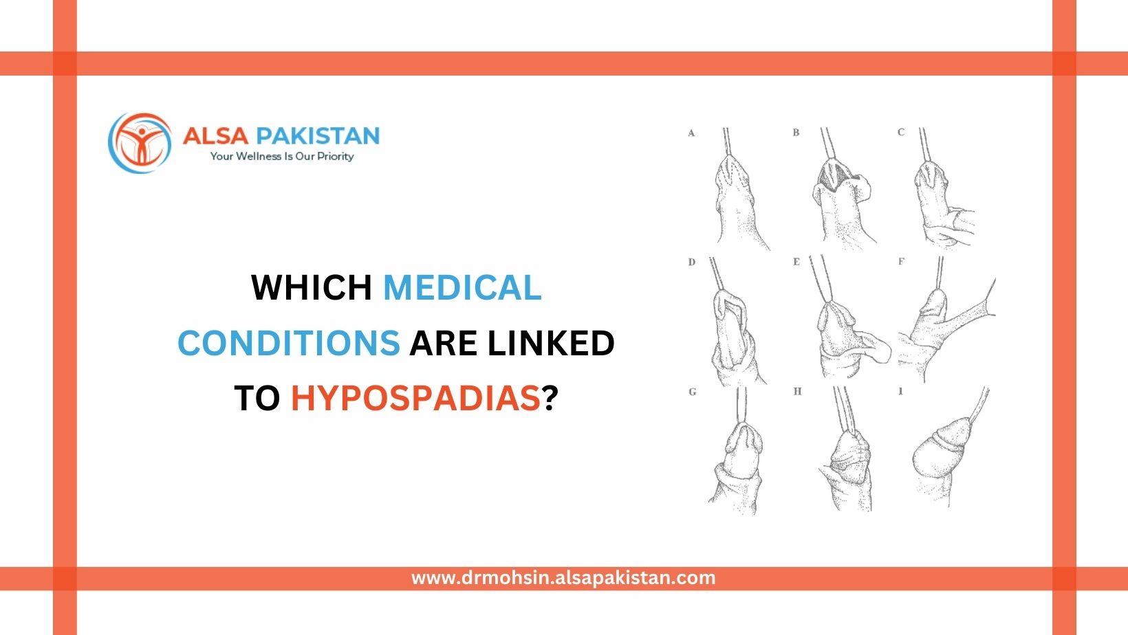 Which medical conditions are linked to hypospadias?