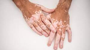 Treatment for vitiligo