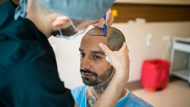 FUE Hair Transplant UK: Your Path to Restoration